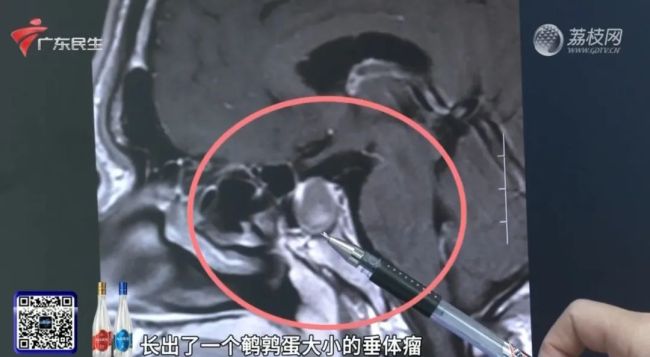 男子突然变丑 下唇比上唇厚一倍 竟是垂体瘤作祟